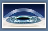 Verisyse™ Phakic Intraocular Lens